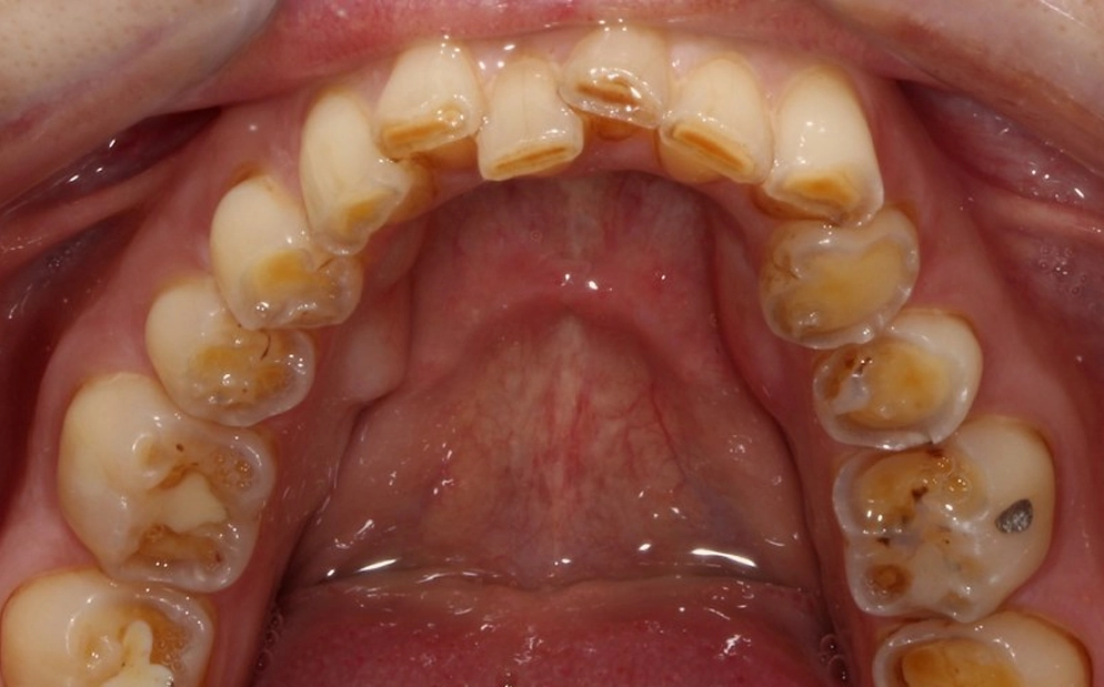 epentheta_prin