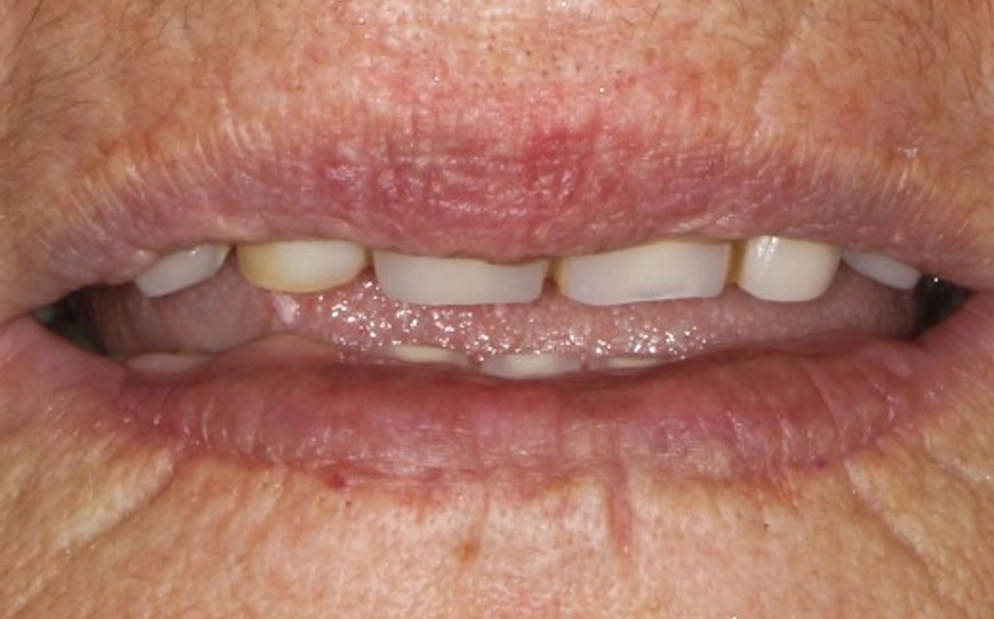 odontostixies_prin